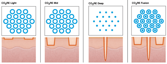 CO2RE fractional laser