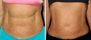 thermage cpt before and after