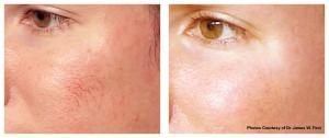 VBeam Perfecta laser treatment
