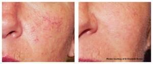 VBeam Perfecta laser treatment before and after